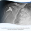 HemiCAP Shoulder Tech Guide
