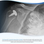 HemiCAP Shoulder Tech Guide