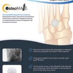 OsteoMate Foot Tech Guide
