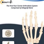 OsteoMate Wrist Tech Guide