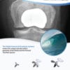 Patellofemoral Tech Guide
